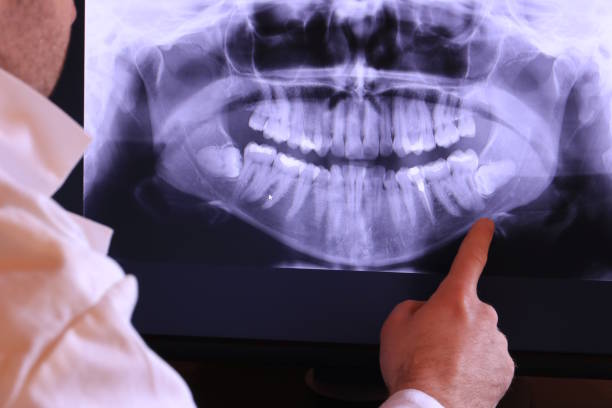 Best Emergency Wisdom Teeth Removal in Pascagoula, MS